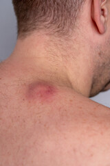 Obraz premium Middle-aged man showing inflamed sebaceous cyst on the back of his neck with visible redness, swelling and irritation; close-up medical view of skin lesion and lump