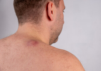 Man is showing a sebaceous cyst, atheroma, or lipoma on his upper back near the neck, indicating a dermatological condition requiring medical attention