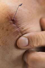 Fototapeta premium A close-up shot captures a healing surgical wound on human skin with a single blue suture still intact, gently held by a finger.