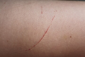 Scratches and redness on a woman&rsquo;s leg caused by a pet, showing mild irritation and small healing wounds. Concept of pet-related injury, home care, and recovery.