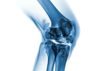 Medical X-ray image of a human knee, revealing bone structures in shades of blue