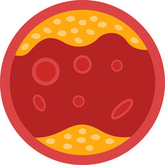 Illustration of Artery Clogged with Cholesterol