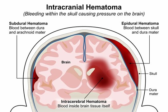 Intracranial Hematoma, Types of Brain Bleeding Flashcard