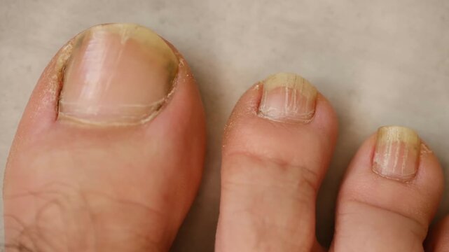 Closeup person foot with unhealthy, yellowed, and damaged toenails, common symptom of onychomycosis, nail fungal infection requiring podiatry treatment, care. Person toes showing nail fungus infection