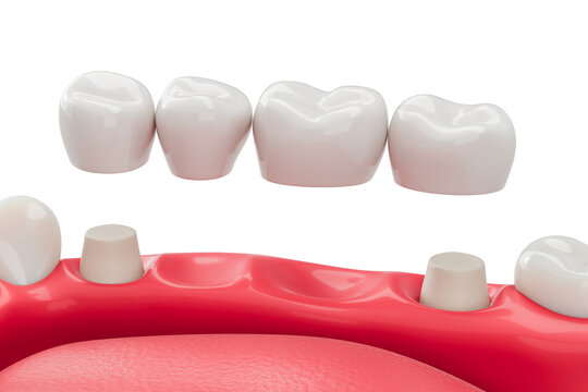 Dental bridge installation concept showing prosthetic teeth and abutment preparation on gum model for restorative dentistry procedure. 3D Rendering