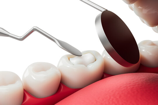Dental filling procedure concept showing tooth restoration with tools on molars and gums during treatment, close-up view on white background. 3D Rendering