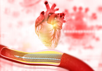 Human heart angioplasty, stent implantation. 3d illustration
