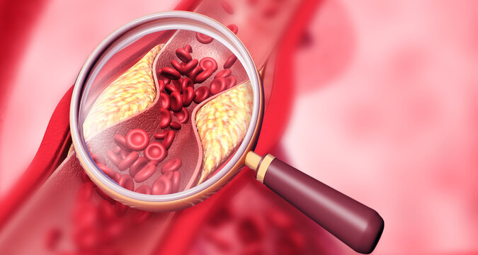 Magnifying glass with clogged arteries. 3d illustration