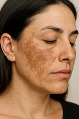 Close-Up of Woman’s Cheek with Melasma Skin Pigmentation 