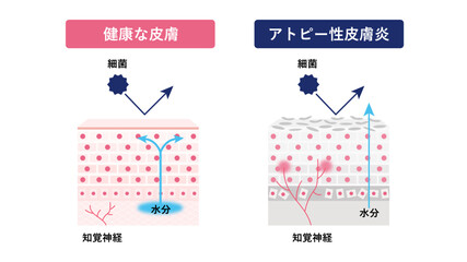 アトピー性皮膚炎