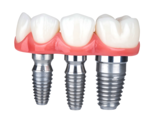 Dental bridge on three implants, showcasing artificial teeth set in pink gum-like material