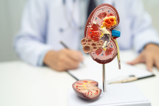 Chronic kidney disease ckd, Doctor hold human model to treat and study in hospital.