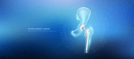 Hip replacement. Prosthetic implant integrated into the femur bone. Orthopedic technology artificial joint surgery in a transparent anatomical. Medical health care vector.