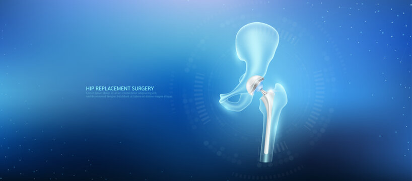 Hip replacement. Prosthetic implant integrated into the femur bone. Orthopedic technology artificial joint surgery in a transparent anatomical. Medical health care vector.