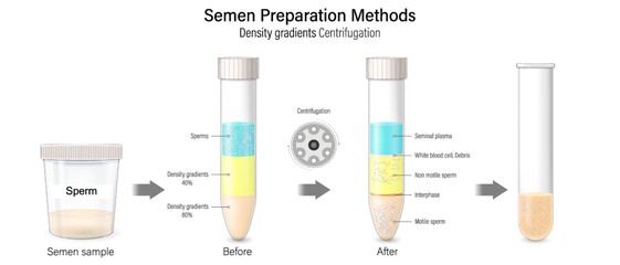 Semen Preparation Methods-Density gradients Centrifugation. Sperm selection for IVF. In-Vitro Fertilization. Fertility treatment. Assisted reproductive technology.
