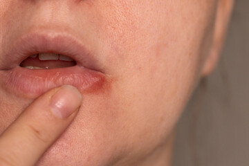Obraz premium Close-up detail shows finger touching a cold sore on the lower lip of a woman's face. Skin is visible around the lips. Redness and swelling indicate Herpes simplex virus.