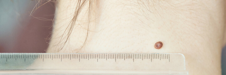 Close-up of a caucasian females skin mole with ruler for measurement detail and examination.