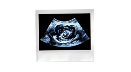 Expecting a new life with this ultrasound image showing a developing baby in the womb during the early stages of pregnancy Generative AI