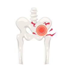 Illustration of Pelvic Bone Pain 