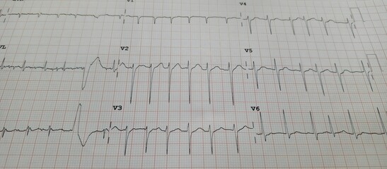 Detailed ECG chart showing labeled leads and waveforms used to assess heart rhythm and diagnose cardiac conditions.
