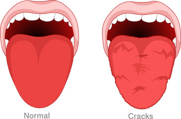 Fissured tongue is also known as scrotal tongue or lingua plicata. Benign condition. Oral diseases. Vector illustration
