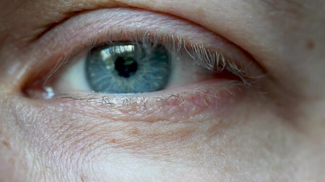 Closeup of man open blue eye with lower eyelid nerve tic due to stress and fatigue. Peron with eyelid twitch-myokymia. Neuro spasm of eyelid muscles. Fatigue from working long hours at computer