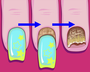 Nail plate disease. Nail plate fungus. Healthcare illustration. Vector illustration.