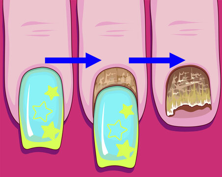 Nail plate disease. Nail plate fungus. Healthcare illustration. Vector illustration.