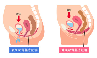 衰えた骨盤底筋群と健康な骨盤底筋群
