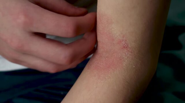 Child with atopic dermatitis scratching irritated and itchy red skin on the elbow crease