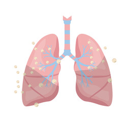 Pneumonia Illustration