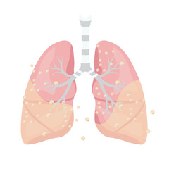 Pneumonia Illustration