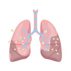 Pneumonia Illustration