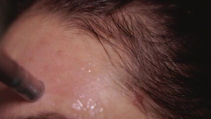 Woman using dermapen on face, cheeks, forehead and around the mouth. Female with pigmentation spots and rosacea taking care of her skin at home. Concept of skincare and facial rejuvenation.