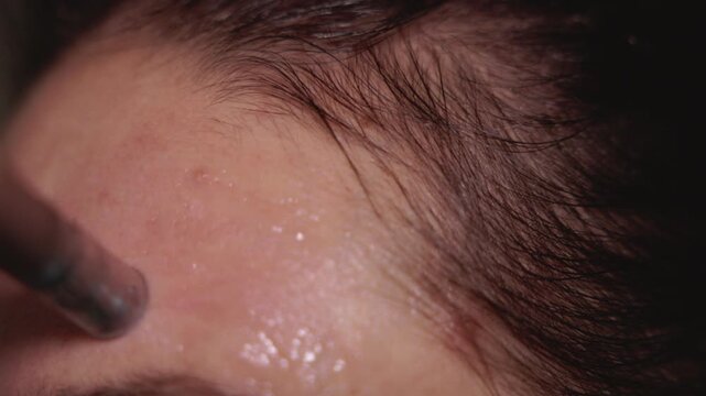 Woman using dermapen on face, cheeks, forehead and around the mouth. Female with pigmentation spots and rosacea taking care of her skin at home. Concept of skincare and facial rejuvenation.