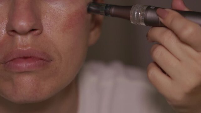 Woman using dermapen on face, cheeks, forehead and around the mouth. Female with pigmentation spots and rosacea taking care of her skin at home. Concept of skincare and facial rejuvenation.