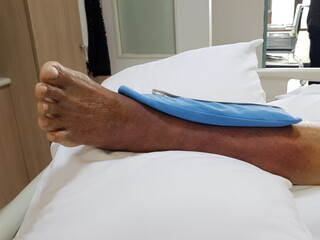 Purpura caused by cancer on leg is side effect of chemotherapy or caused by cancer cells interfering with platelet production in the bone marrow.