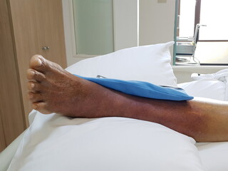 Purpura caused by cancer on leg is side effect of chemotherapy or caused by cancer cells interfering with platelet production in the bone marrow.