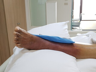 Purpura caused by cancer on leg is side effect of chemotherapy or caused by cancer cells interfering with platelet production in the bone marrow.
