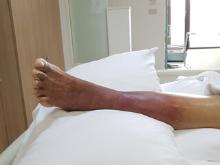 Purpura caused by cancer on leg is side effect of chemotherapy or caused by cancer cells interfering with platelet production in the bone marrow.