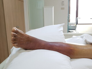 Purpura caused by cancer on leg is side effect of chemotherapy or caused by cancer cells interfering with platelet production in the bone marrow.
