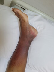 Purpura caused by cancer on leg is side effect of chemotherapy or caused by cancer cells interfering with platelet production in the bone marrow.