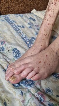Close-up static shot of an elderly person's feet resting on a bed, showing skin with red spots and purpura. Long, thick, yellow toenails indicate possible onychomycosis or poor foot hygiene.