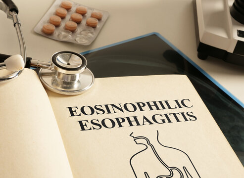Eosinophilic esophagitis EOE is shown using the text as medical concept