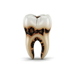 Tooth with decay problem for dental health treatment concep on a white background