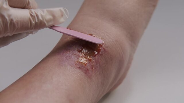 Doctor applying healing ointment to recovering wound on woman leg, treating female ankle, medical treatment skin injury, healthcare support and recovery rehabilitation, patient care, injury healing