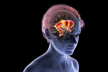 Normal pressure hydrocephalus, 3D illustration