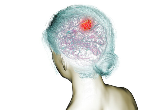 Brain tumor, 3D illustration