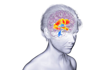 Enlarged lateral ventricles of the brain, 3D illustration