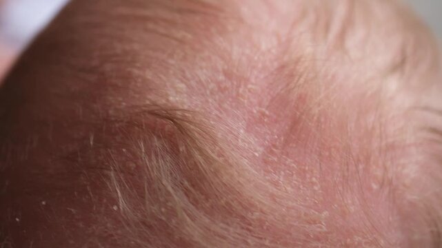 Detailed view of a newborn baby's scalp showing cradle cap, also known as infantile seborrheic dermatitis, a common skin condition characterized by crusty, flaky, and scaly patches